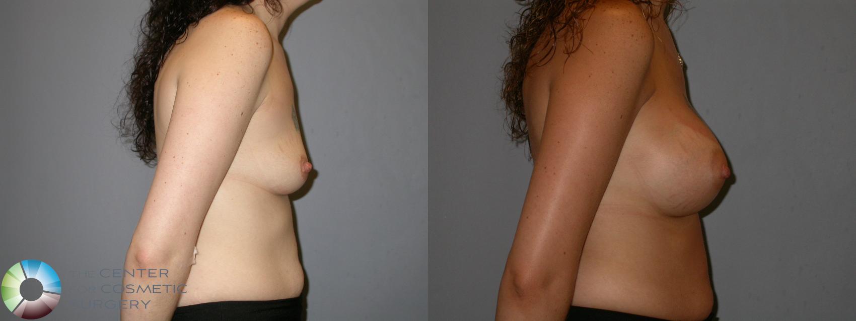 Before & After Breast Augmentation Case 173 View #3 View in Golden, CO
