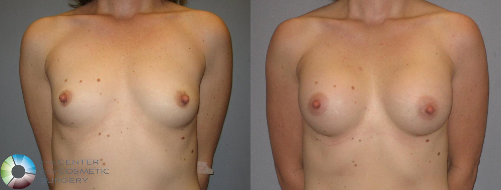 Before & After Breast Augmentation Case 174 View #1 in Denver and Colorado Springs, CO