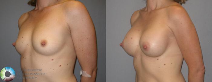 Before & After Breast Augmentation Case 174 View #2 in Denver and Colorado Springs, CO