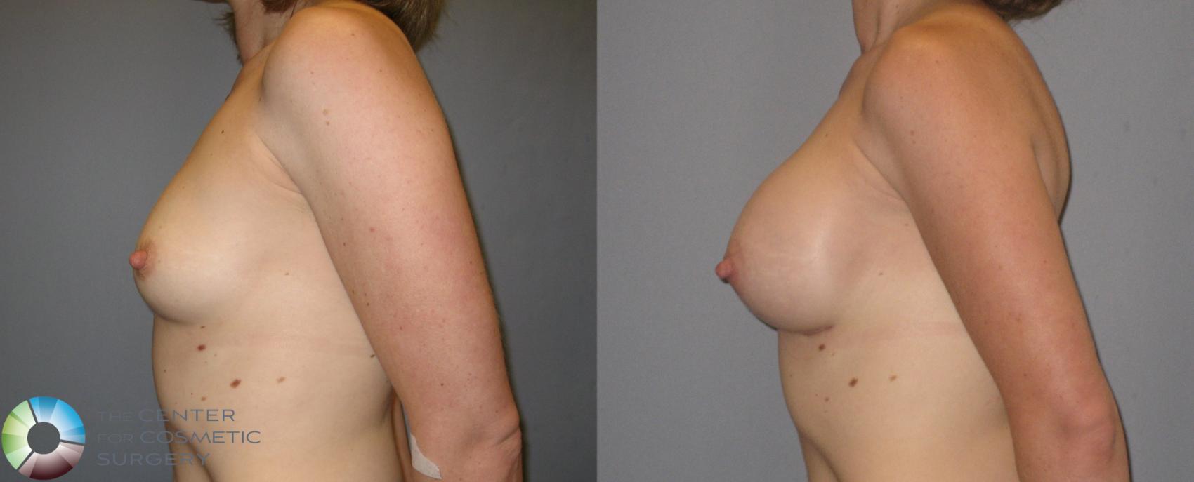 Before & After Breast Augmentation Case 174 View #3 in Denver and Colorado Springs, CO