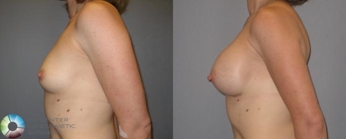 Before & After Breast Augmentation Case 174 View #3 in Denver and Colorado Springs, CO