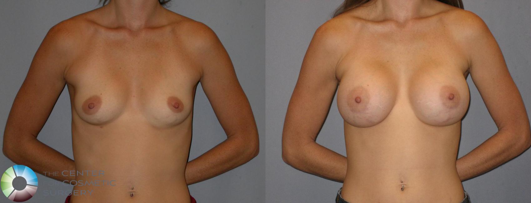 Before & After Breast Augmentation Case 175 View #1 in Denver and Colorado Springs, CO