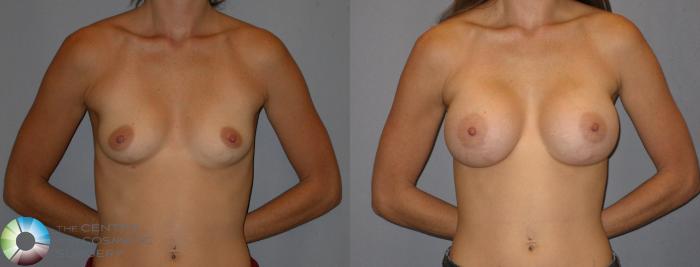 Before & After Breast Augmentation Case 175 View #1 View in Golden, CO