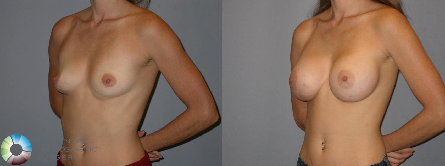 Before & After Breast Augmentation Case 175 View #2 in Denver and Colorado Springs, CO