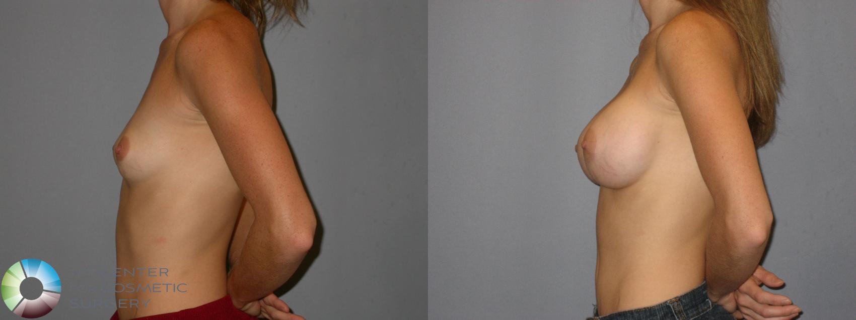 Before & After Breast Augmentation Case 175 View #3 in Denver and Colorado Springs, CO
