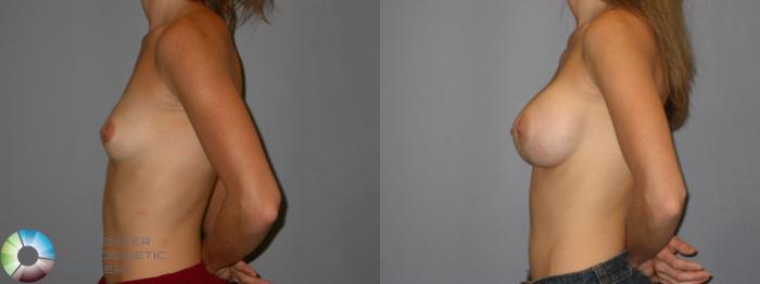 Before & After Breast Augmentation Case 175 View #3 View in Golden, CO