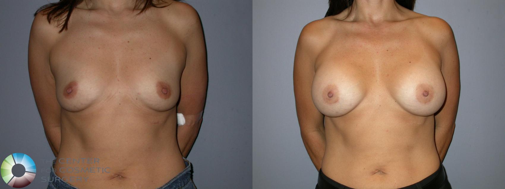 Before & After Breast Augmentation Case 176 View #1 in Denver and Colorado Springs, CO