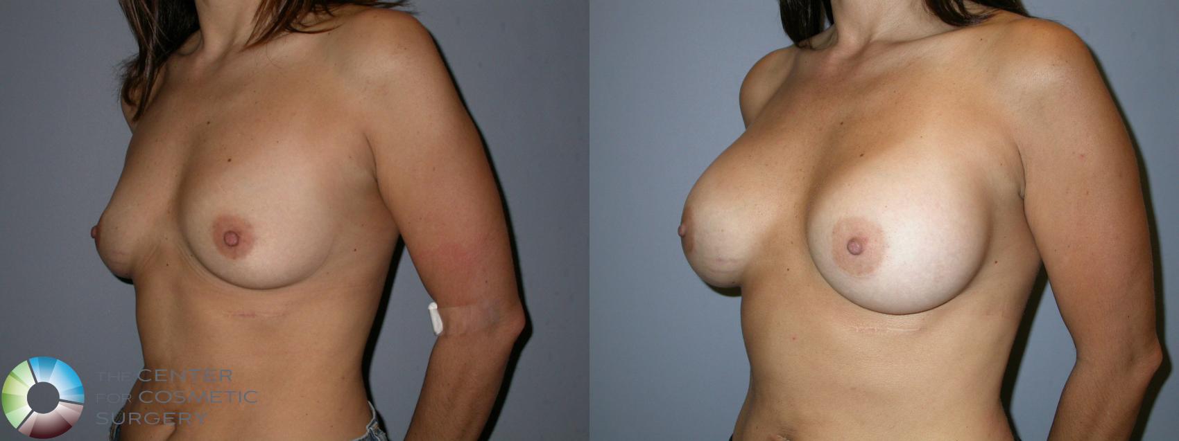 Before & After Breast Augmentation Case 176 View #2 in Denver and Colorado Springs, CO