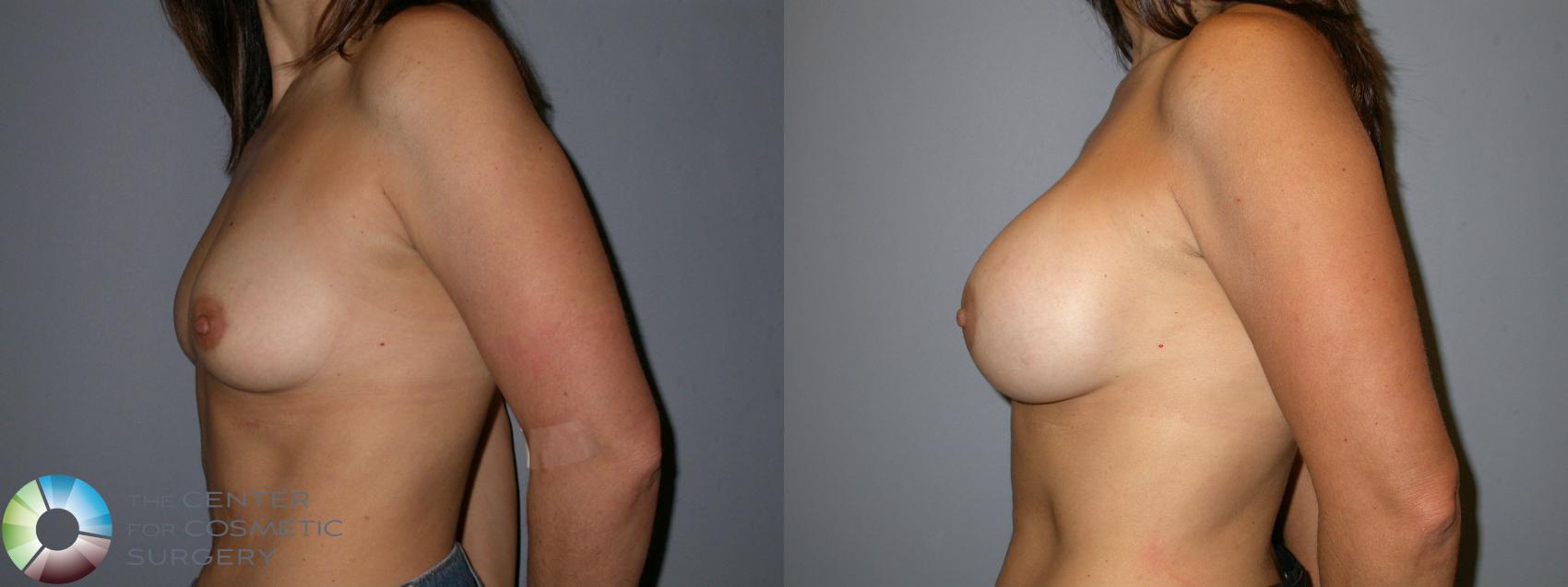 Before & After Breast Augmentation Case 176 View #3 in Denver and Colorado Springs, CO