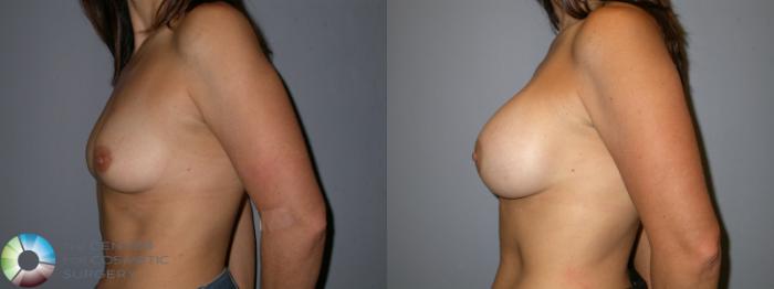 Before & After Breast Augmentation Case 176 View #3 View in Golden, CO