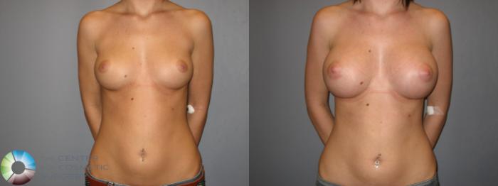 Before & After Breast Augmentation Case 177 View #1 in Denver and Colorado Springs, CO