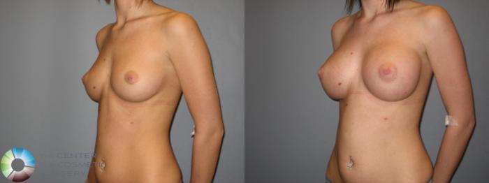 Before & After Breast Augmentation Case 177 View #2 in Denver and Colorado Springs, CO