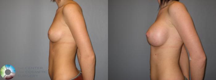 Before & After Breast Augmentation Case 177 View #3 in Denver and Colorado Springs, CO