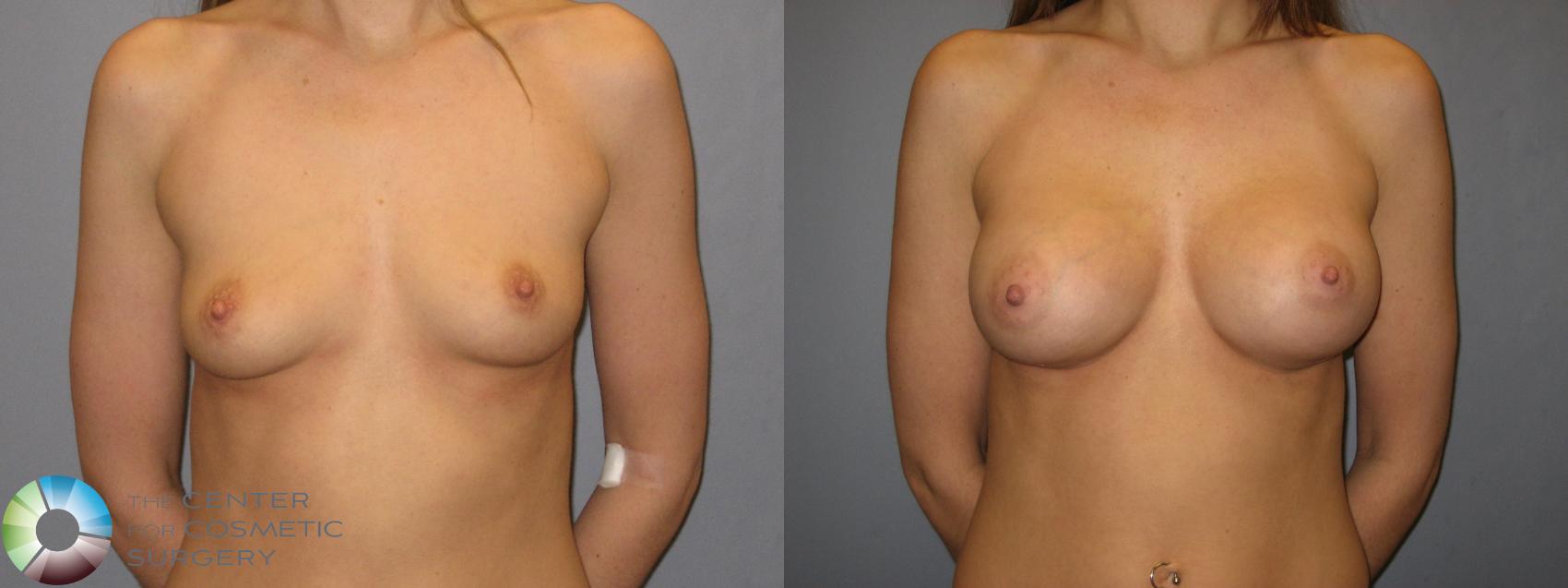 Before & After Breast Augmentation Case 178 View #1 in Denver and Colorado Springs, CO