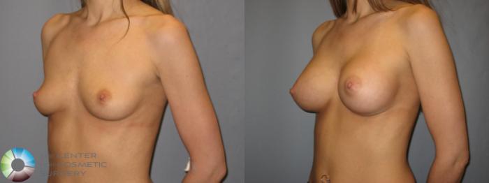Before & After Breast Augmentation Case 178 View #2 in Denver and Colorado Springs, CO
