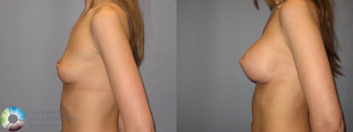 Before & After Breast Augmentation Case 178 View #3 in Denver and Colorado Springs, CO