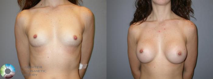 Before & After Breast Augmentation Case 179 View #1 View in Golden, CO