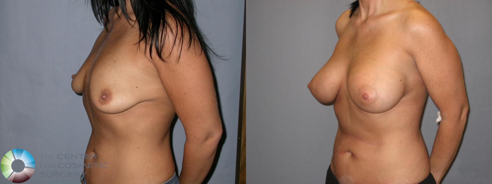Before & After Breast Augmentation Case 182 View #2 View in Golden, CO