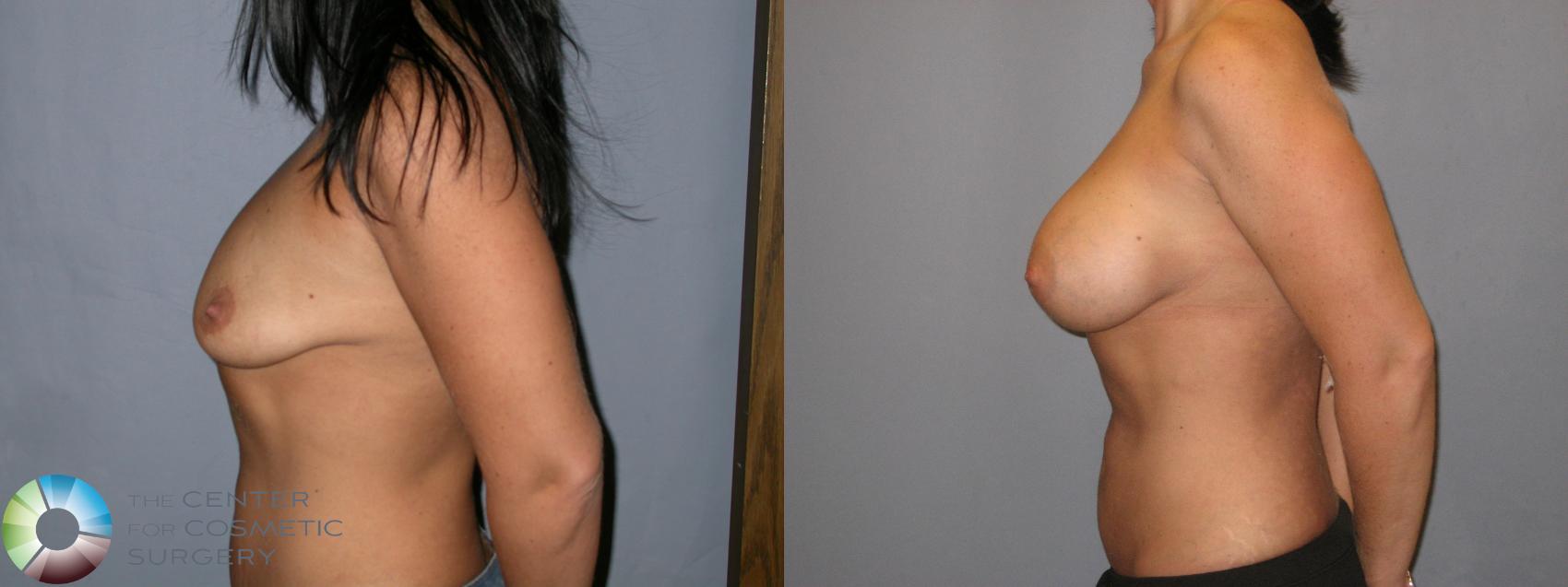 Before & After Breast Augmentation Case 182 View #3 View in Golden, CO