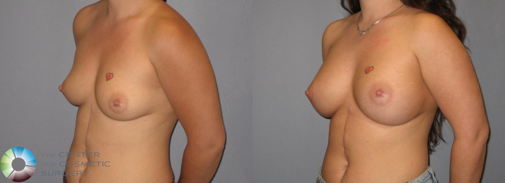 Before & After Breast Augmentation Case 183 View #1 in Denver and Colorado Springs, CO