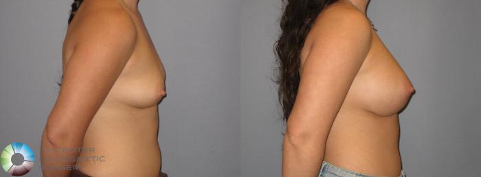 Before & After Breast Augmentation Case 183 View #2 View in Golden, CO