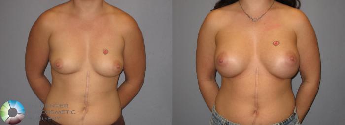 Before & After Breast Augmentation Case 183 View #3 View in Golden, CO