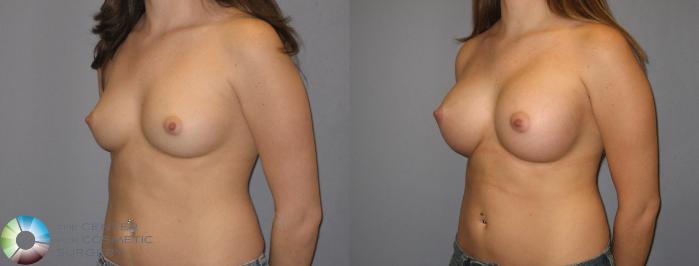 Before & After Breast Augmentation Case 184 View #1 View in Golden, CO