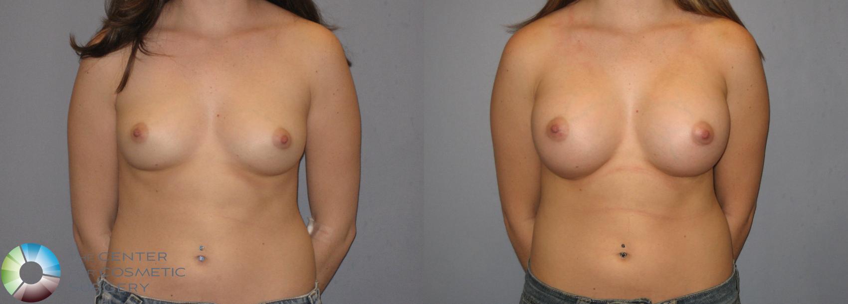 Before & After Breast Augmentation Case 184 View #2 in Denver and Colorado Springs, CO
