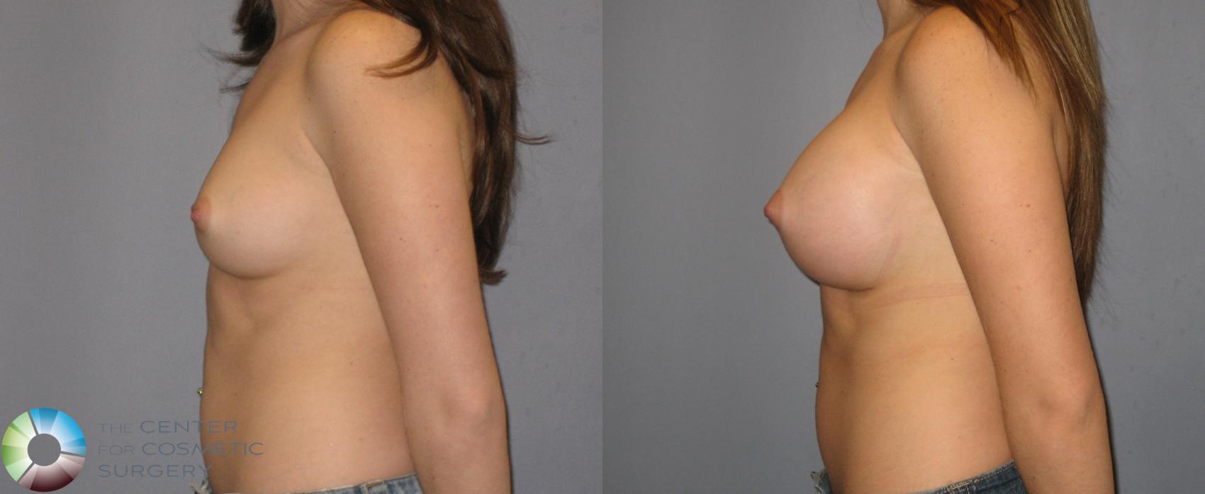 Before & After Breast Augmentation Case 184 View #3 in Denver and Colorado Springs, CO