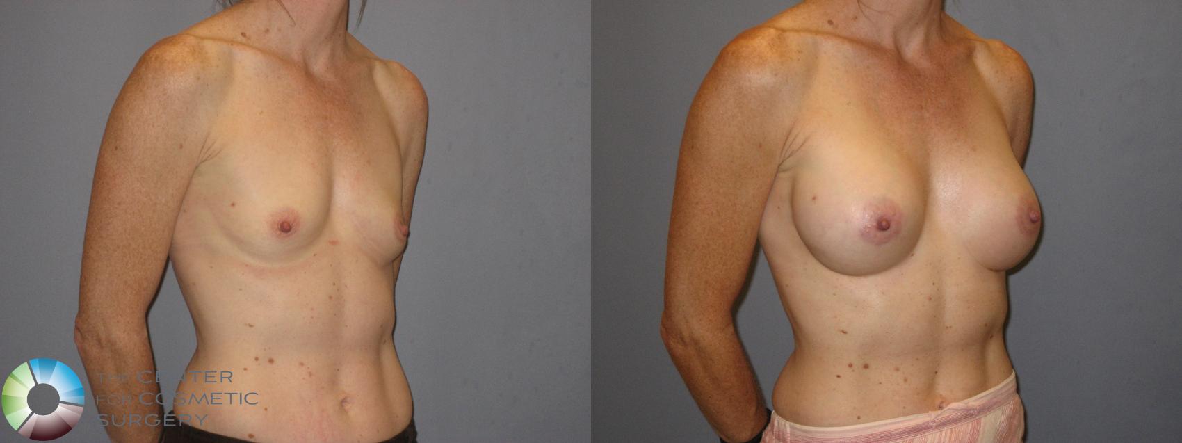 Before & After Breast Augmentation Case 185 View #1 in Denver and Colorado Springs, CO