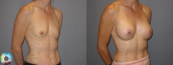 Before & After Breast Augmentation Case 185 View #1 View in Golden, CO