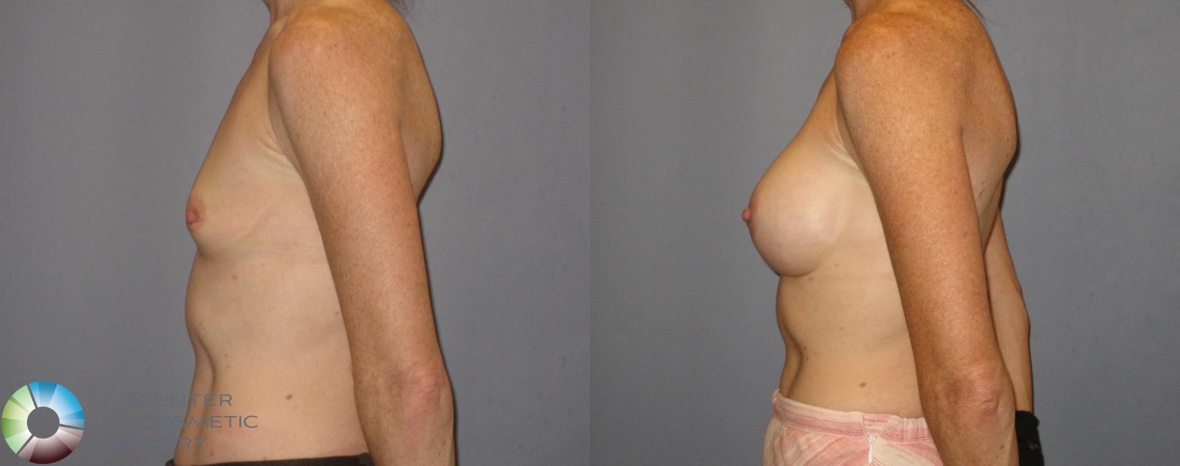 Before & After Breast Augmentation Case 185 View #2 View in Golden, CO