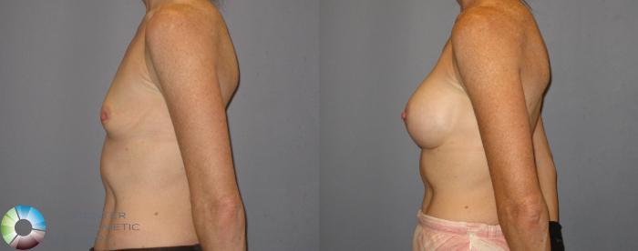 Before & After Breast Augmentation Case 185 View #2 View in Golden, CO