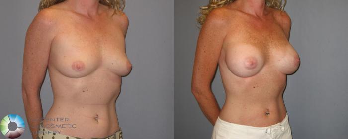 Before & After Breast Augmentation Case 186 View #1 in Denver and Colorado Springs, CO