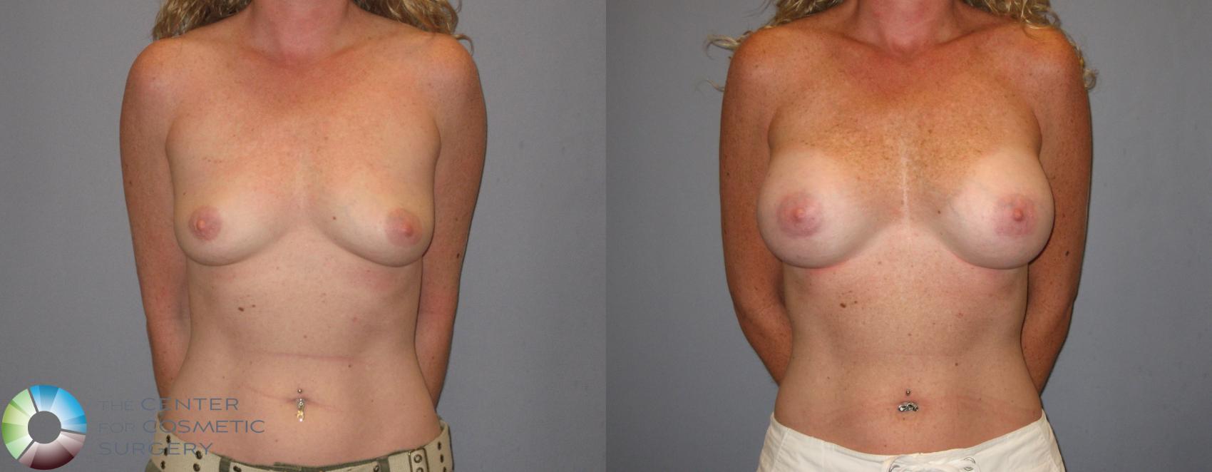 Before & After Breast Augmentation Case 186 View #2 in Denver and Colorado Springs, CO