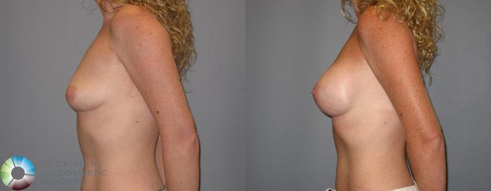 Before & After Breast Augmentation Case 186 View #3 in Denver and Colorado Springs, CO