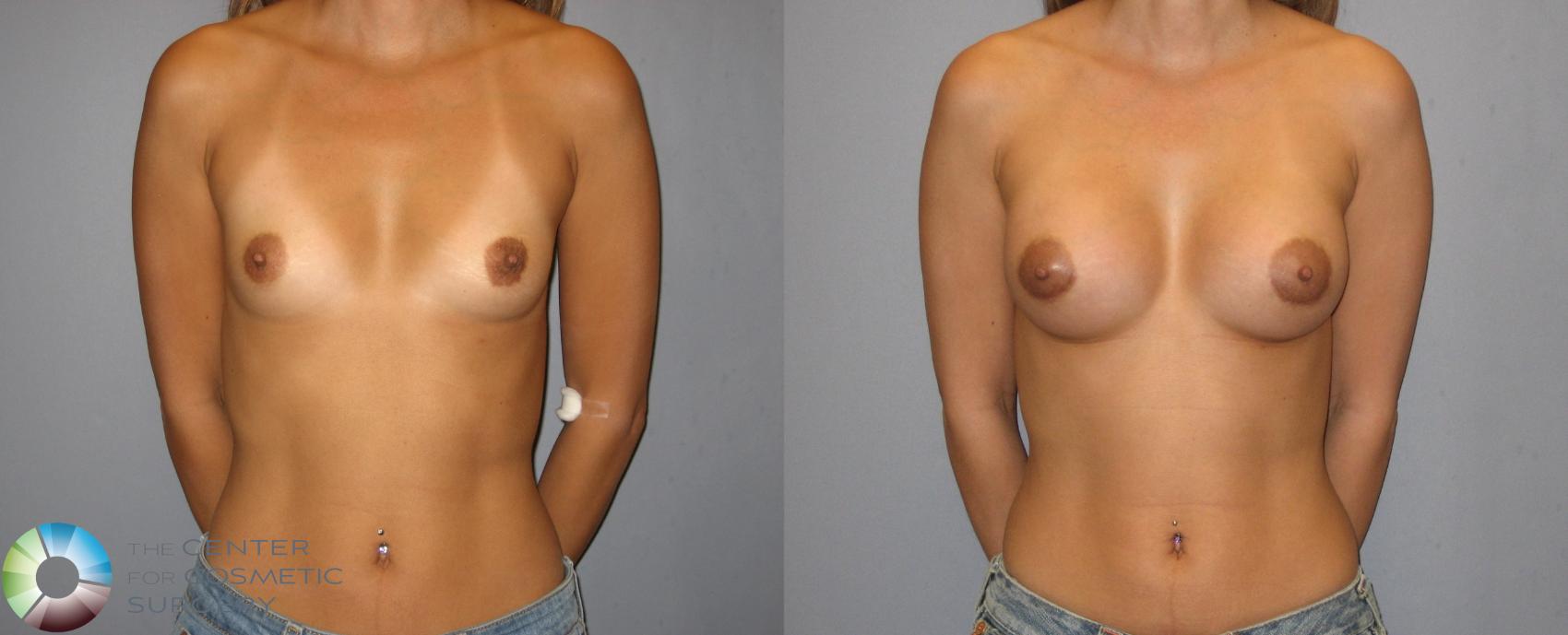 Before & After Breast Augmentation Case 187 View #1 in Denver and Colorado Springs, CO