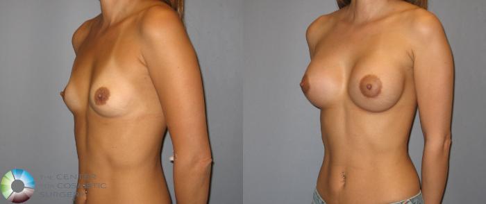 Before & After Breast Augmentation Case 187 View #2 View in Golden, CO