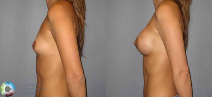 Before & After Breast Augmentation Case 187 View #3 View in Golden, CO
