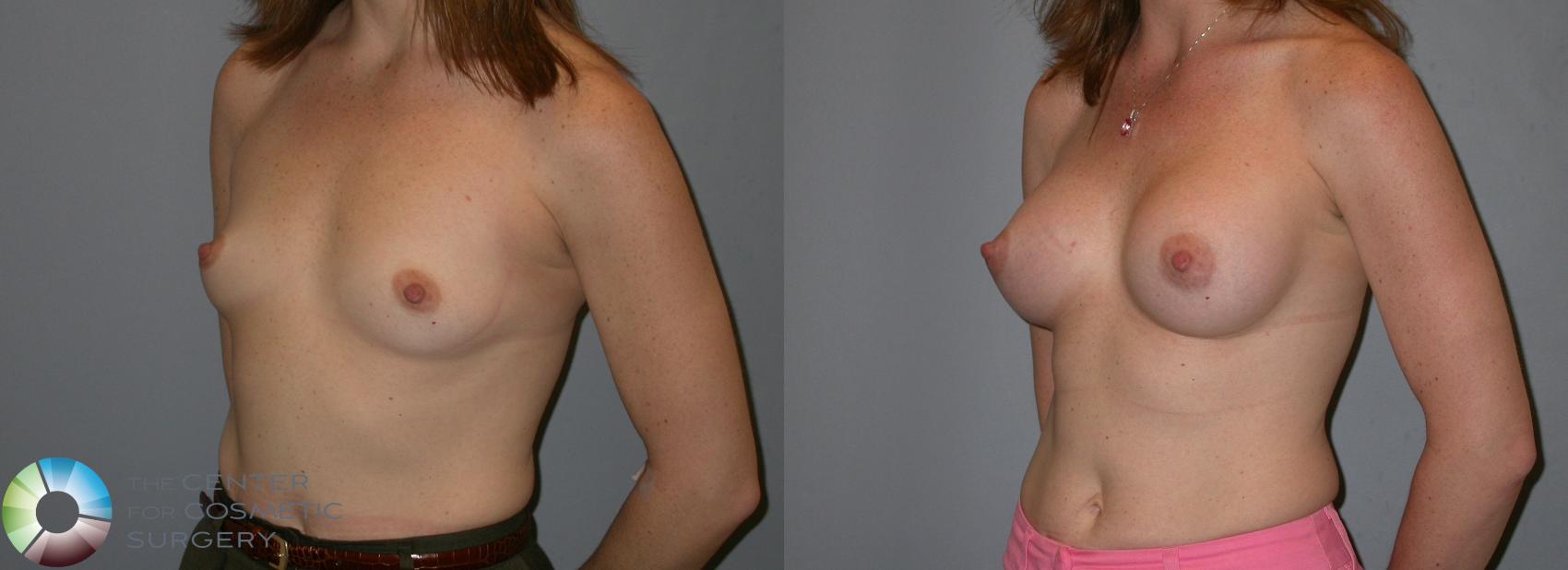 Before & After Breast Augmentation Case 188 View #1 in Denver and Colorado Springs, CO