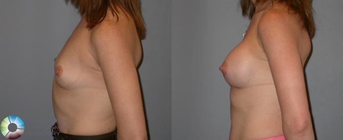 Before & After Breast Augmentation Case 188 View #3 View in Golden, CO