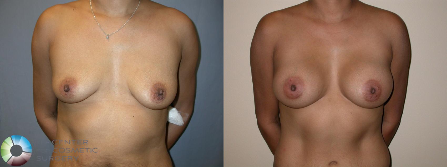 Before & After Breast Augmentation Case 196 View #1 in Denver and Colorado Springs, CO