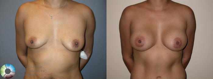 Before & After Breast Augmentation Case 196 View #1 View in Golden, CO