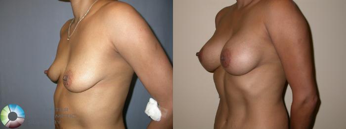 Before & After Breast Augmentation Case 196 View #2 View in Golden, CO