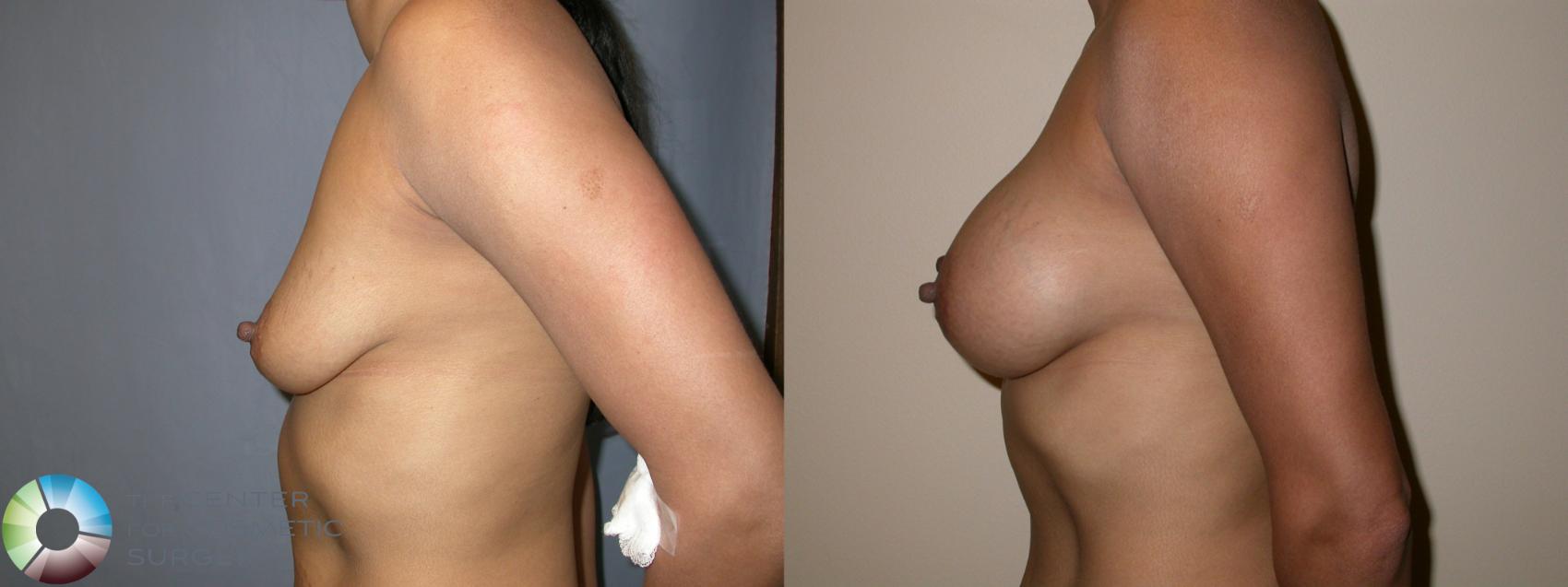 Before & After Breast Augmentation Case 196 View #3 View in Golden, CO
