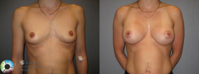 Before & After Breast Augmentation Case 208 View #1 View in Golden, CO
