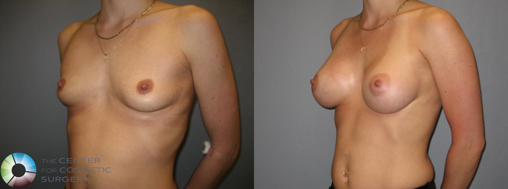 Before & After Breast Augmentation Case 208 View #2 in Denver and Colorado Springs, CO