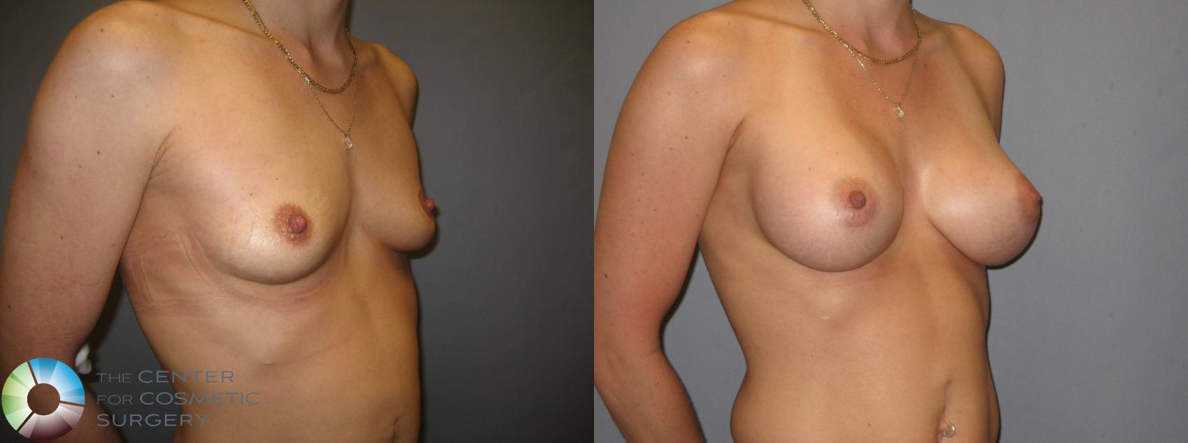Before & After Breast Augmentation Case 208 View #3 in Denver and Colorado Springs, CO