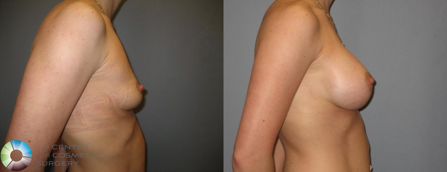 Before & After Breast Augmentation Case 208 View #4 in Denver and Colorado Springs, CO