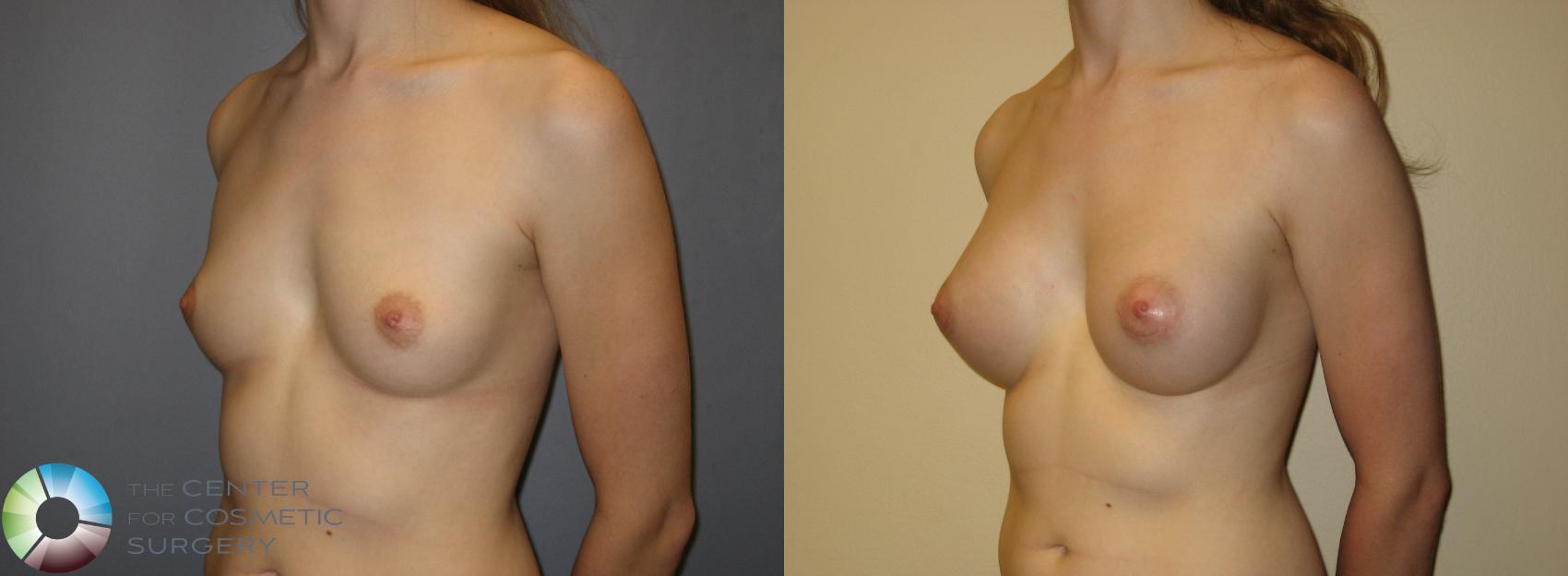 Before & After Breast Augmentation Case 210 View #1 in Denver and Colorado Springs, CO